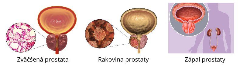 Prostata - zvětšená, rakovina prostaty a prostatitida